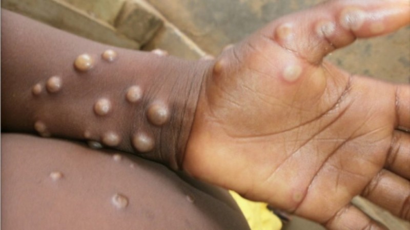 Global Health EDCTP3 Allocates €5 Million to Combat Mpox Epidemic in DRC