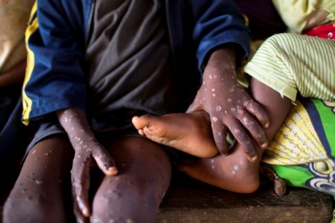 New Mpox Research Network Seeks Urgent Funding Amid Rising Cases in Africa