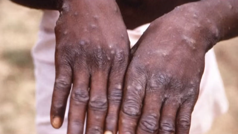 UK Commits £3.1 Million to Support Mpox Outbreak Response in DRC