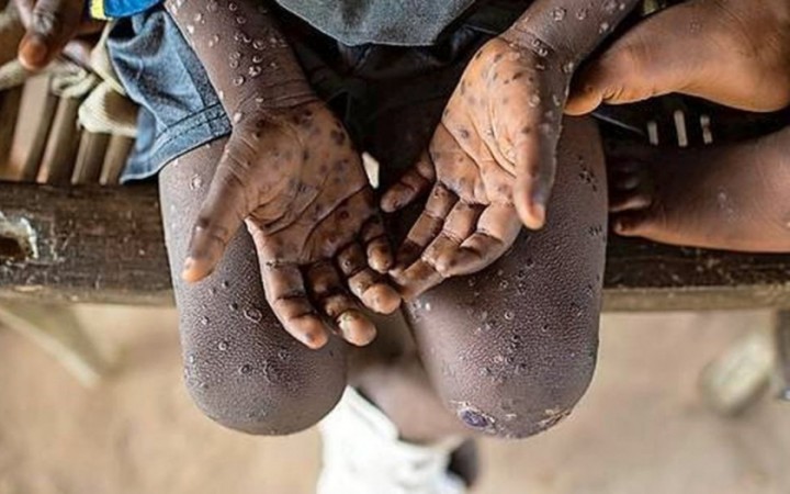 Africa CDC and WHO Launch $600 Million Joint Plan to Tackle Mpox Outbreak